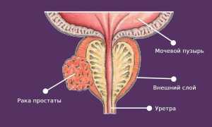Как лечится рак простаты