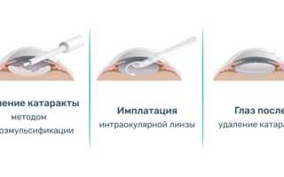 В каких случаях требуется удаление катаракты?
