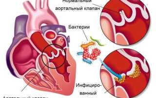 Что такое эндокардит?