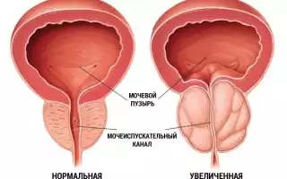 Что нужно знать о простатите?